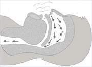 in 4 Canadian adults is at high risk of obstructive sleep apnea based on 3+ risk factors: Loud snoring