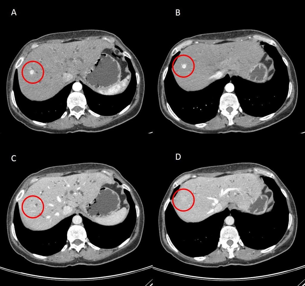 Fig. 7: Dual-phase abdominal CT scan (A and B - arterial phase; C and D - venous phase) in a patient with liver metastases from a duodenal