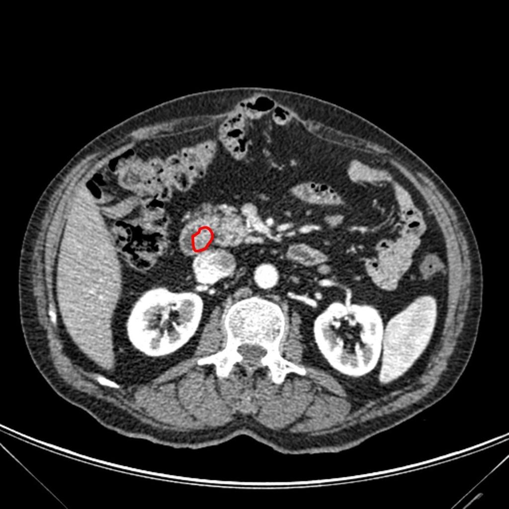 Fig. 2: Duodenal carcinoid with intraluminal small solid mass