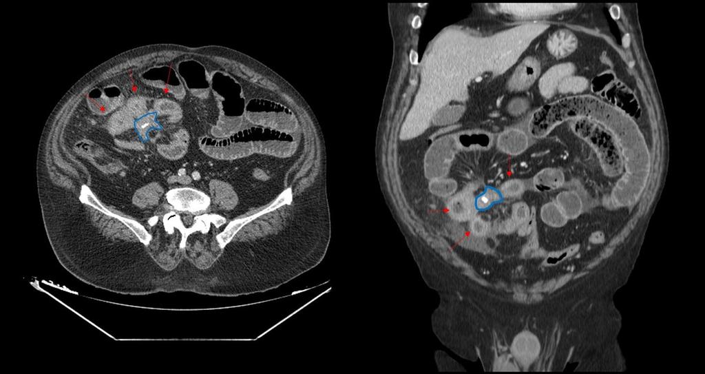 Fig. 4: Obstructive small bowel ileus because of an ileal carcinoid tumor with