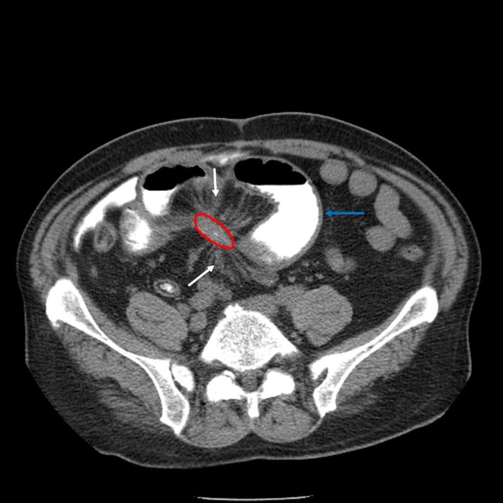 Fig. 5: Small bowel carcinoid (red line) with obstructive small bowel ileus (blue arrow).