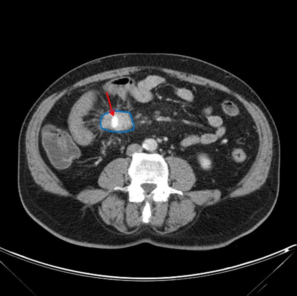 Fig. 6: Small bowel carcinoid with wall thickening and mesenteric extension (blue
