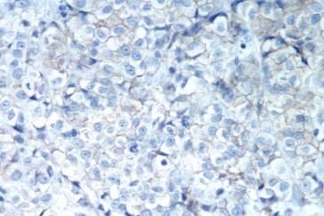 (equivocal) Weak-to-moderate complete membrane staining in >10% of