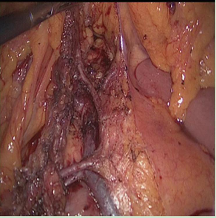 Zhou HT et al. Overlapped delta-shaped anastomosis A B C D E F Figure 2 Surgical procedure.
