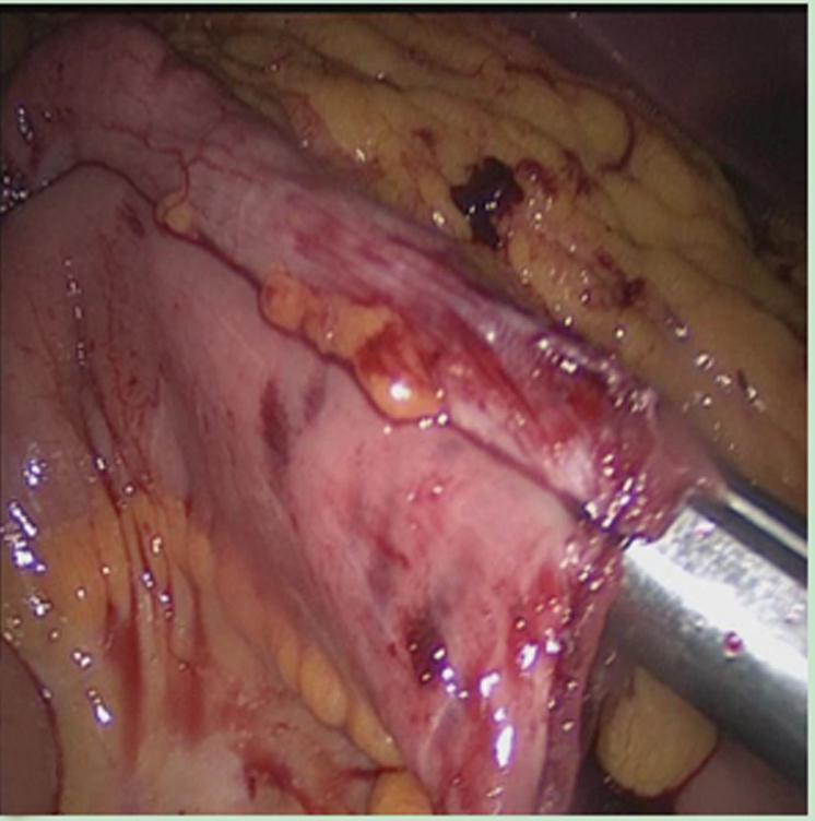 cutter staplers; C: The proximal ileum and the distal transverse colon were fixed in an overlapped fashion using a piece of absorbable suture to facilitate anastomosis; D: After imbedding the lumens