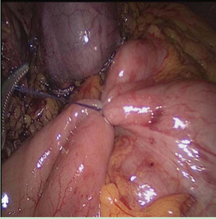 A typical specimen and the transverse incision above the symphysis pubis are shown in Figure 3. The mean follow-up time was 8.5 mo (range: 1-15 mo).