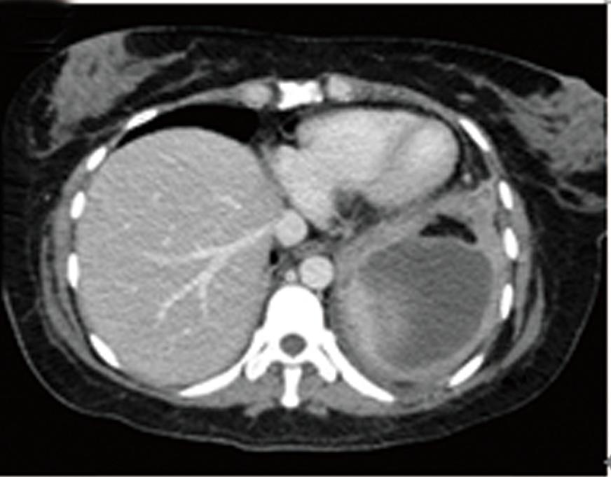 Ng JJ et al. Omental patch for bile duct injury A B C Figure 1 Computed tomography scan.
