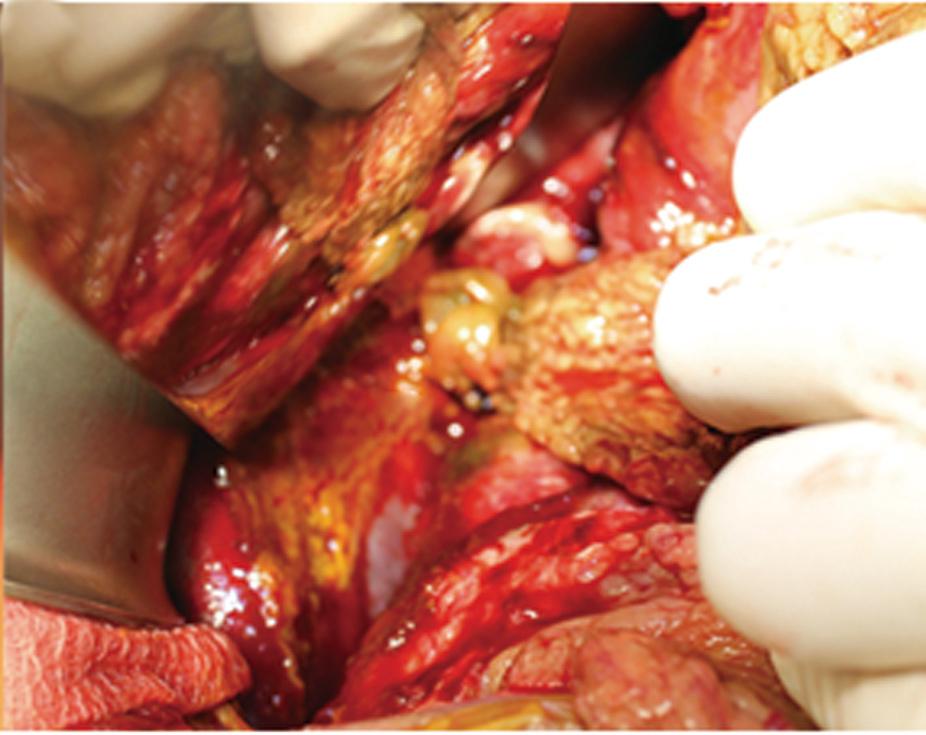 Ng JJ et al. Omental patch for bile duct injury A A B B Figure 3 Damage control surgery.