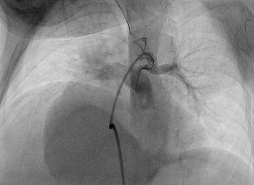 PDA insertion to LPA, LPA stenosis : PDA stent in ductus-related pulmonary coarctation appropriateness of PDA stent?