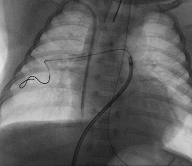 artery New stent implanted