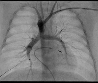 from underneath aortic arch Transvenous trans-vsd