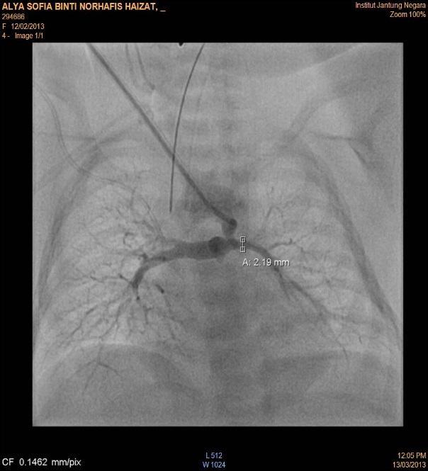 axillary artery Nur aisy Not quite stent friendly -