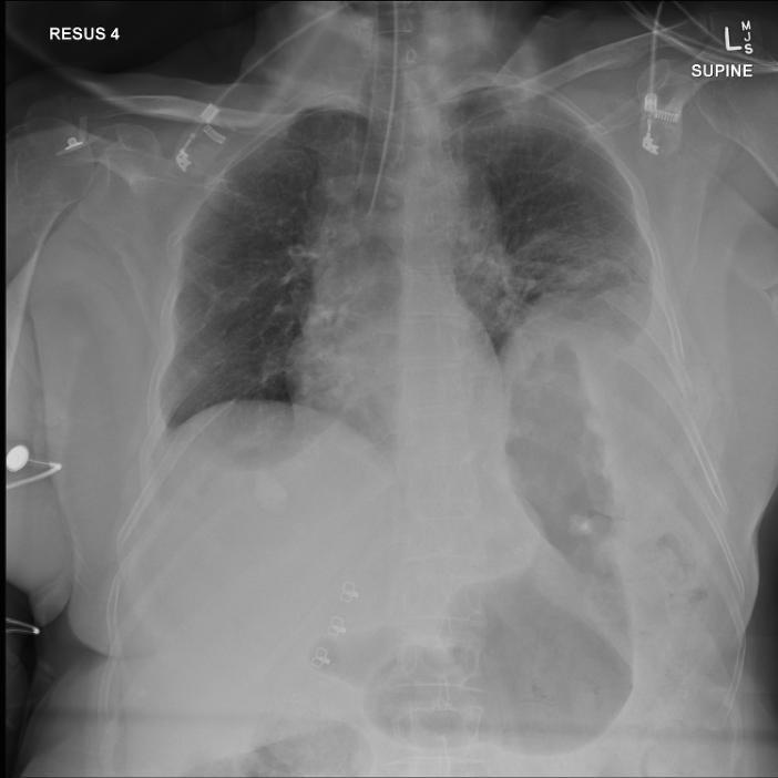 May identify sub-diaphragmatic air (needs to be interpreted with caution as may be from a hollow viscous injury or may be air entrained into the abdomen) May identify a ruptured diaphragm