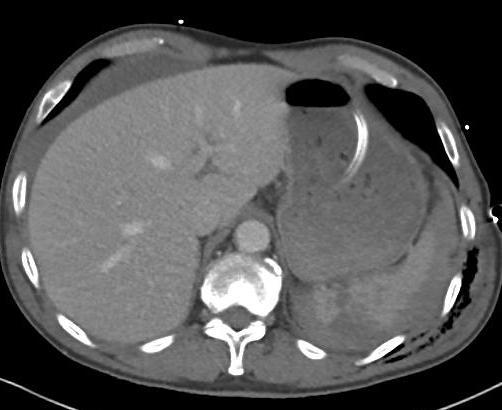 A contrast CT and CT angiogram are invaluable tools to aid in determining whether a patient may potentially benefit from