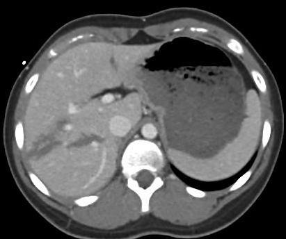 The classic example is the patient with an unstable pelvic fracture and negative FAST.