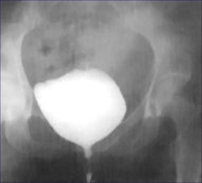 Bladder Trauma: Standard Cystogram Consider urethrogram 10-20% have concurrent urethral injury Minimum 300mL