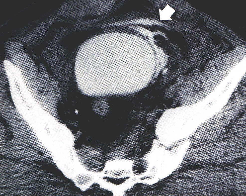 CT Cystogram: Extraperitoneal Rupture