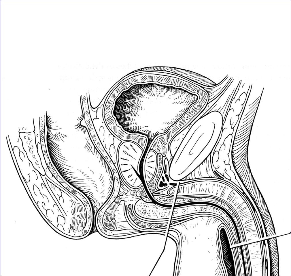 Posterior Urethral Distraction