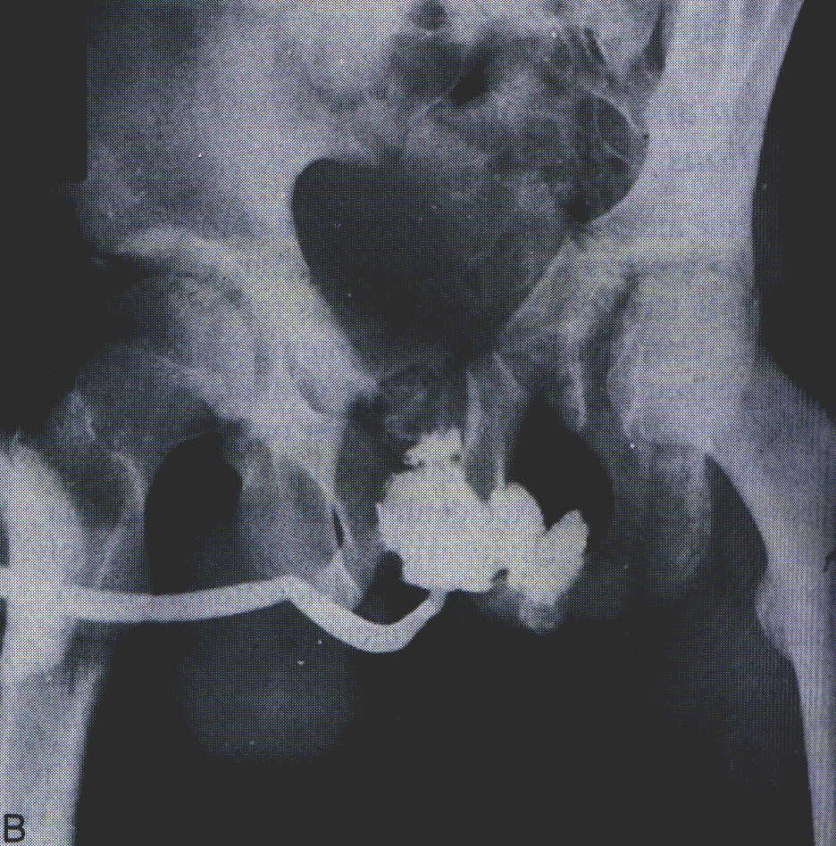 Posterior Urethral Trauma: Diagnosis - Urethrogram Foley 2-3cm into distal urethra 1-2mL balloon