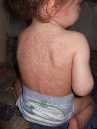 Measles, Mumps and Rubella
