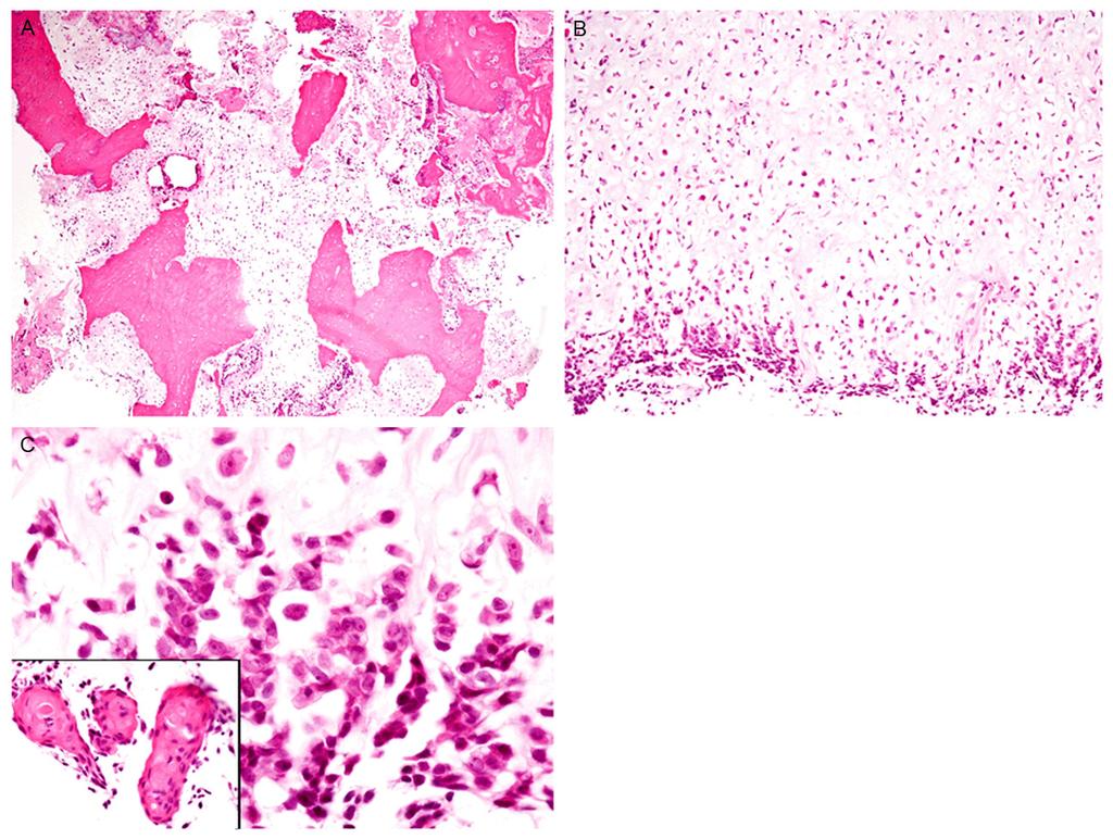 Figure 2. Histopathological features of the biopsy specimen of the fibula tumor. A: Proliferation of irregularshaped lobules of cartilage permeating into the bone trabeculae, HE, x 40.