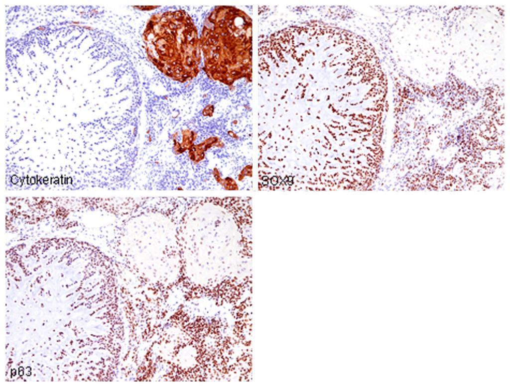 Figure 4. Immunohistochemical features of the fibula tumor. Cytokeratin (AE1/AE3) is expressed only in the squamous cell carcinoma component. p63 is expressed in all three components.