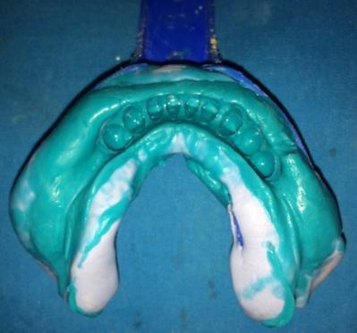 lower arch was made using metal framework as tray. In this way dual impression was made i.e. edentulous portion in functional form and dentulous portion in anatomic form (Fig no.
