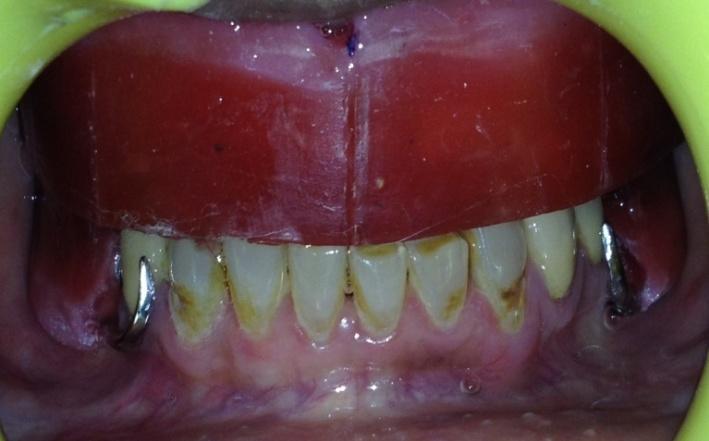 After processing of final denture, metal housings of ball attachments were picked up in denture using cold