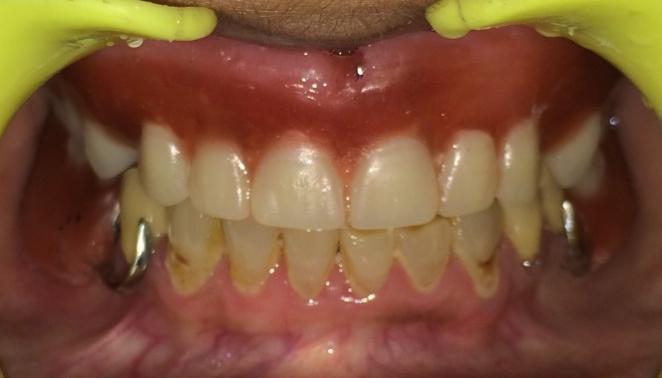 Fig no.13- Try in Fig no.13 Finished denture with female part incorporated Fig no.14 Patient with Final prosthesis III.