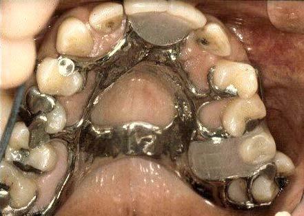 interproximal space one-tooth removed why?