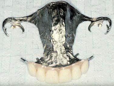 posterior teeth remaining on each side; preferably molars and on
