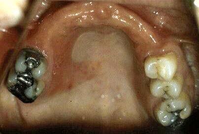 below with a closed horseshoe (ant/post palatal