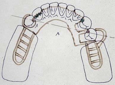 Class I Premolar abutments - Mandible Primary rests Indirect Retainer rests Clasp