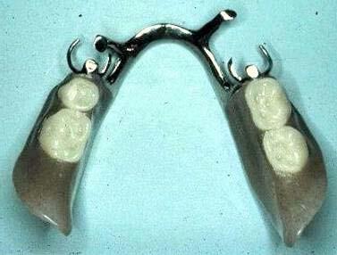 Lingual bar with 30ga relief Indirect retainer rests Think about the pros and cons