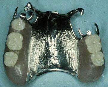 connector Primary fulcrum line Anterior border of palatal plate ending in
