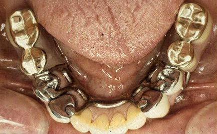 Class I Premolar abutments Combination case Gold occlusals allow for