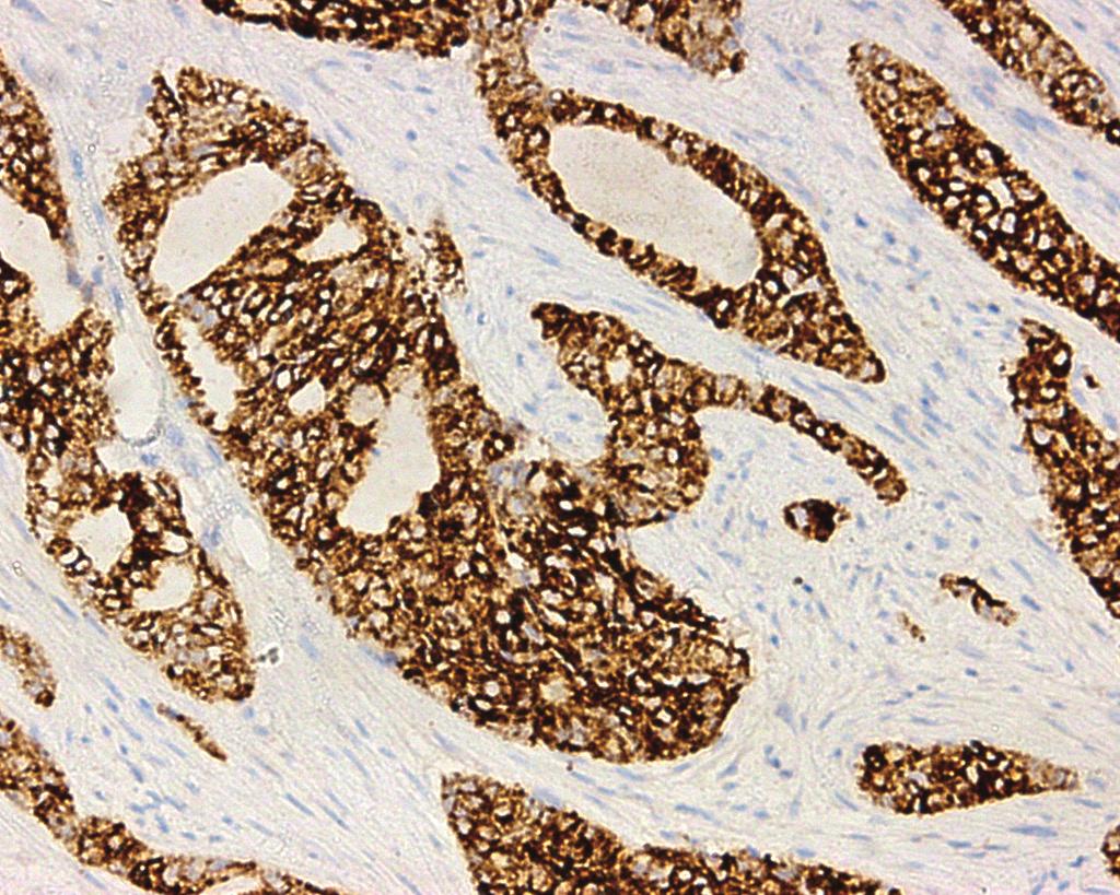 antibody, together with the Optiview DAB IHC detection kit and Optiview Amplification kit on the Benchmark XT stainer.