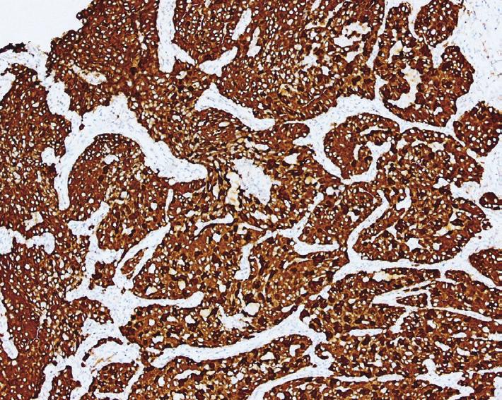 Thoracotomy biopsy indicated solid predominant adenocarcinoma (A, 10, HE staining), ALK-D5F3 positive (B, 10, immunohistochemistry).