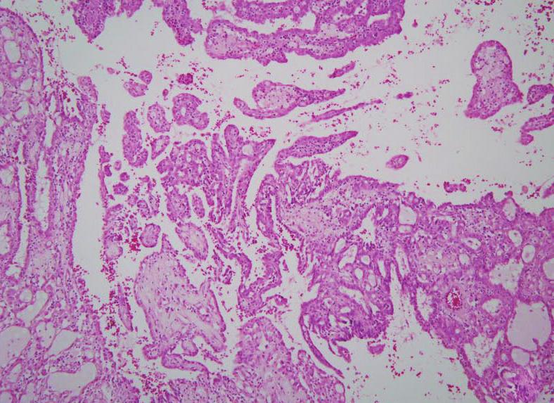 Microscopically, the tumor showed a papillary, tubular or solid pattern with occasional foam cell collections. Tumor cells were columnar or cuboidal cells with abundant eosinophilic cytoplasm (Fig.