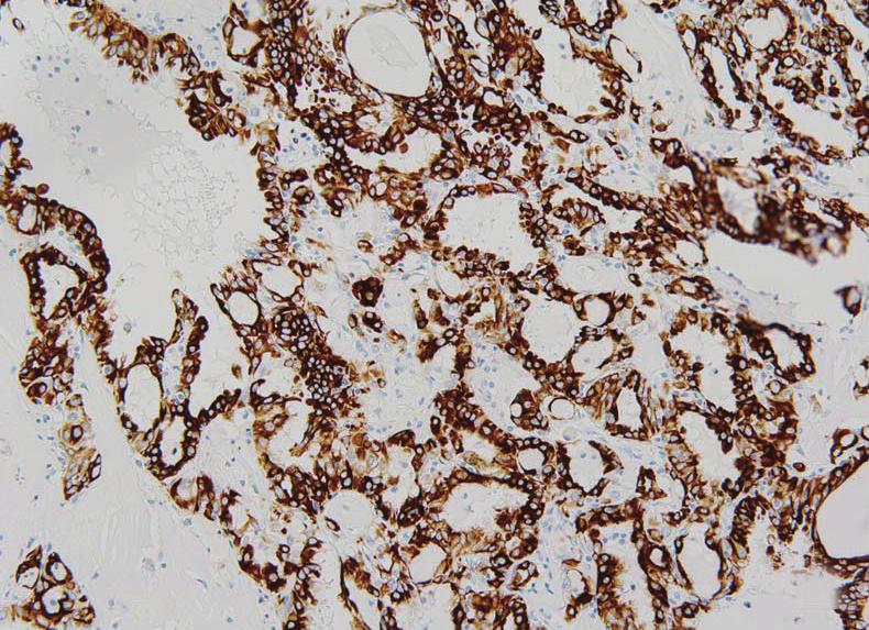 ALK-Positive RCC 455 A B C D Fig.. Immunohistochemical findings of renal cell carcinoma showing anaplastic lymphoma kinase (ALK) rearrangement.