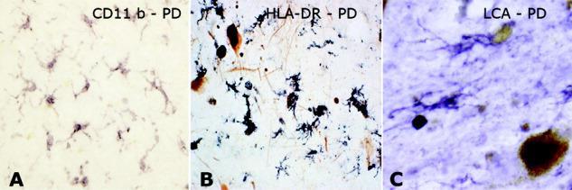 Inflammation in human PD PD McGeer and McGeer, Mov Disorders, 2008 Microglial activation is a constant