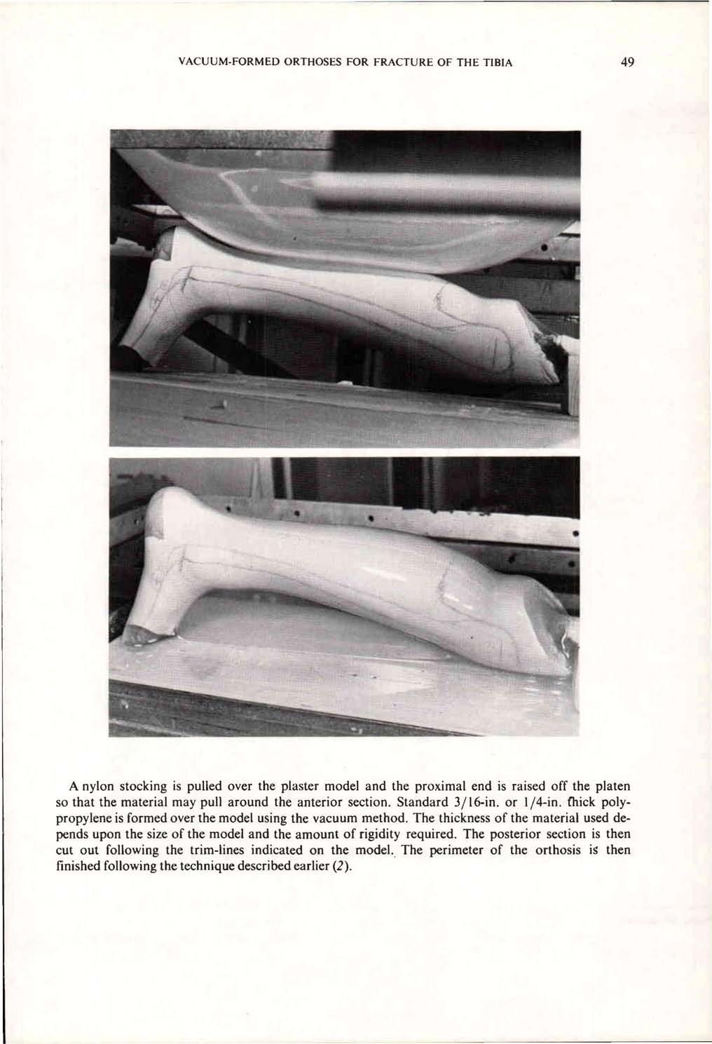 A nylon stocking is pulled over the plaster model and the proximal end is raised off the platen so that the material may pull around the anterior section. Standard 3/16-in. or 1/4-in.