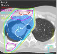 Tumor more anterior Lung posterior Case 2 T2 tumor