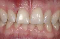 treated right central incisor. The CTG resulted in preserving the cervical soft-tissue root prominence and also corrected the recession on the left lateral incisor.