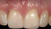 The decision was made to use orthodontics to correct the occlusion and tooth position of the adjacent teeth.