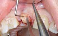 Forced eruption of the incisor also would move the fracture more coronal and create a healthy environment prior to implant placement.