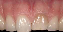 COLLABORATIVE MANAGEMENT OF ESTHETIC DILEMMAS Case 4 In this case, the patient had a large advanced periodontal defect on the mesial aspect of her