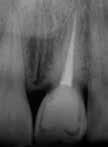 The final restorative treatment plan will include a porcelain veneer on the right central incisor when the patient has the implant final