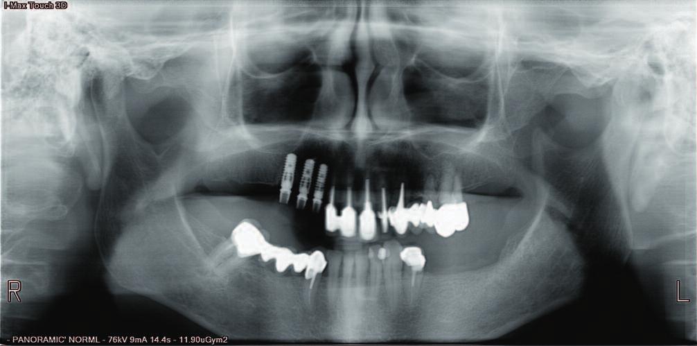 Results Immediate implant placement associated with immediate loading is a predictable protocol with some variables.