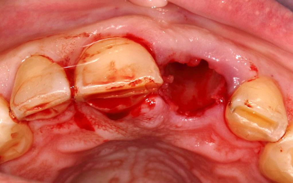 The clinical examination showed along with the missing clinical crown of the incisor, a vertical root fracture. The probing depth buccally at the level of the fracture was 14mm.
